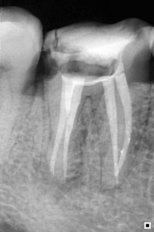Conometría molar 4 conductos