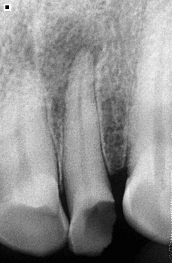 Diagnóstico endodoncia uniradicular